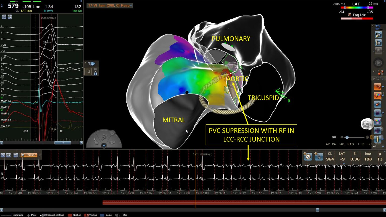 Left Ventricular summit for ablation Cardiac Anatomy for