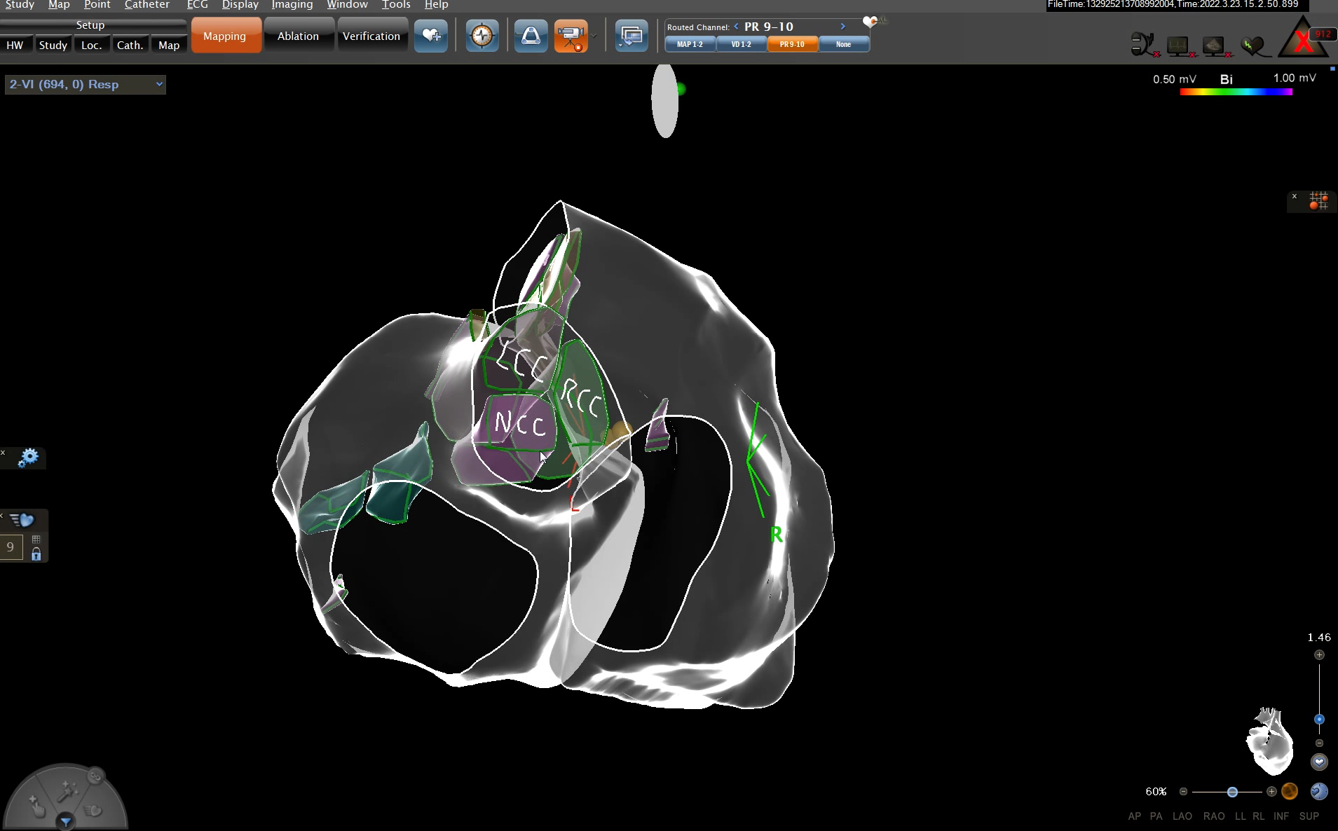 Left ventricular summit / 3D reconstruction 