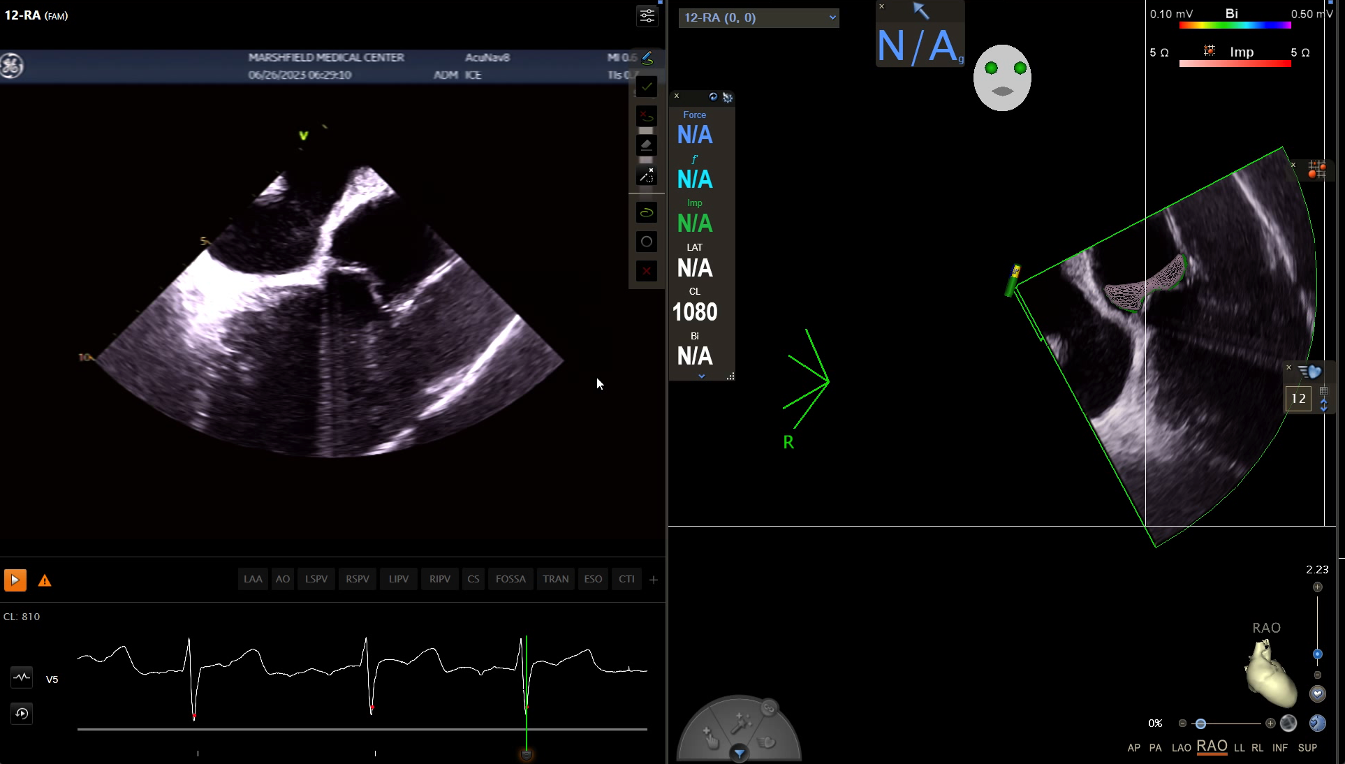 Video 2. Left atrial structures for transseptal access 