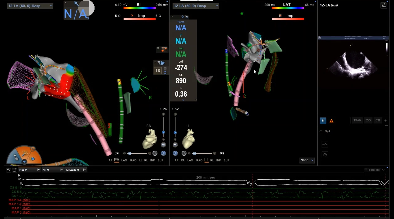Video 6. Fast anatomical map (FAM) of the LA