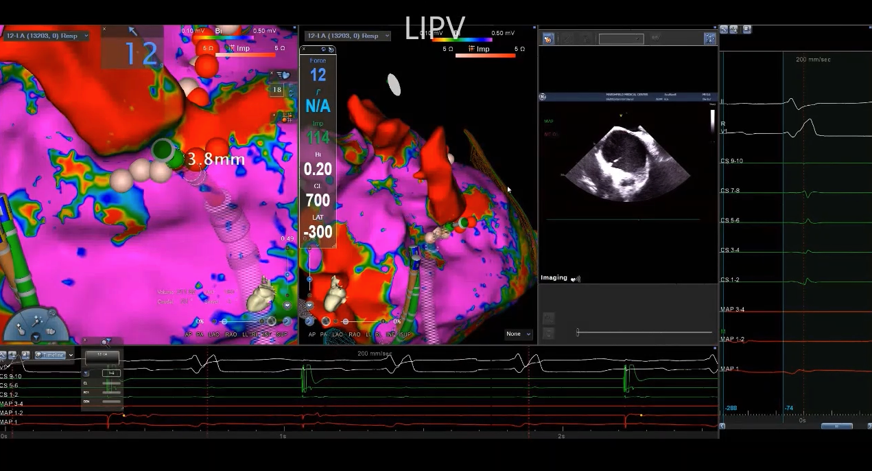Video 7. ICE and 3DEAM guided ablation